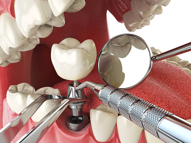 Best Emergency Tooth Extraction in Mount Clemens, MI